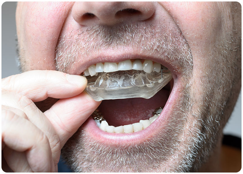 Bruxism Grinding Appliances | River Harmony Dental | General & Family Dentist | Cochrane | Alberta