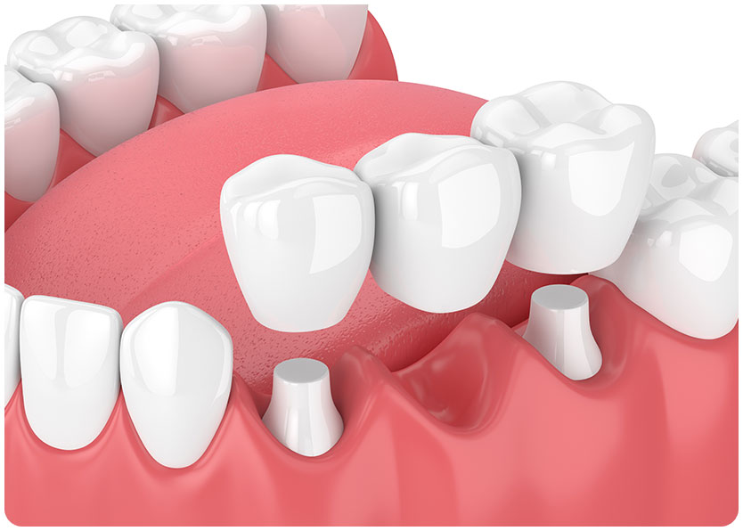 Dental Bridge | River Harmony Dental | General & Family Dentist | Cochrane | Alberta