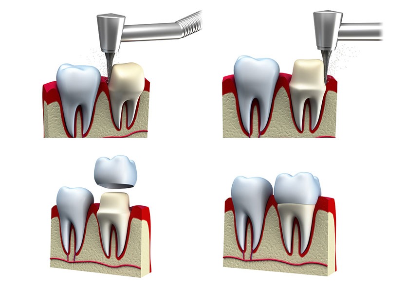 Dental Crowns | River Harmony Dental | General & Family Dentist | Cochrane | Alberta