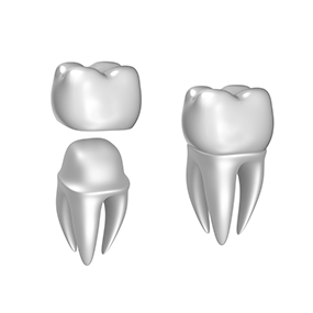 Dental Crowns | River Harmony Dental | General & Family Dentist | Cochrane | Alberta