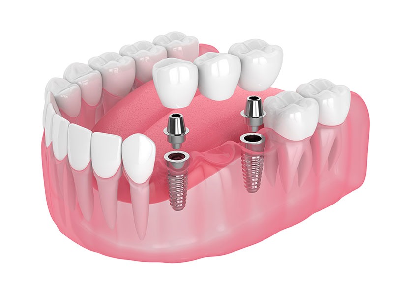 Dental Implants | River Harmony Dental | General & Family Dentist | Cochrane | Alberta