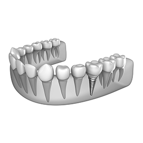 Dental Implants | River Harmony Dental | General & Family Dentist | Cochrane | Alberta