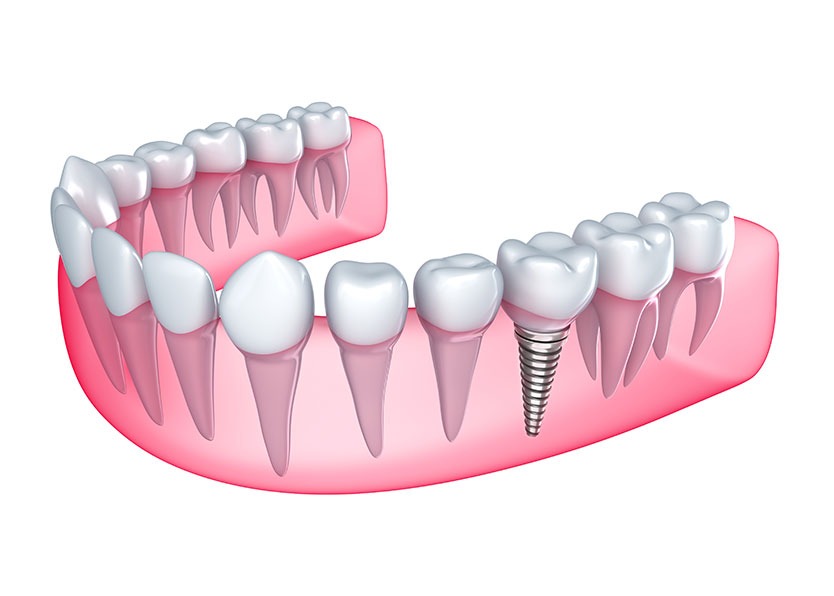 Dental Implants | River Harmony Dental | General & Family Dentist | Cochrane | Alberta