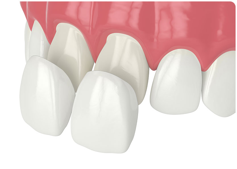 Porcelain Dental Veneers | River Harmony Dental | General & Family Dentist | Cochrane | Alberta