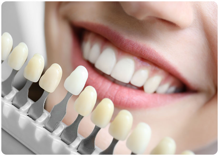 Porcelain Veneers | River Harmony Dental | General & Family Dentist | Cochrane | Alberta