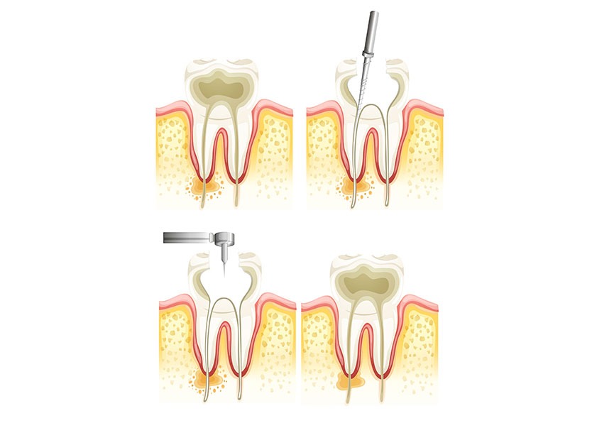 Root Canal Therapy | River Harmony Dental | General & Family Dentist | Cochrane | Alberta