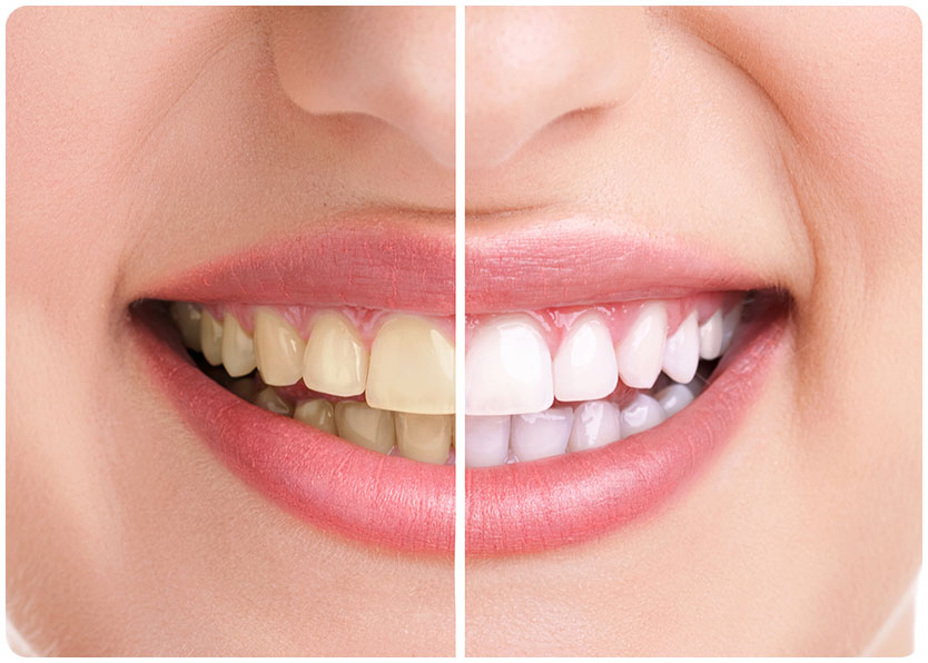 Teeth Whitening | River Harmony Dental | General & Family Dentist | Cochrane | Alberta