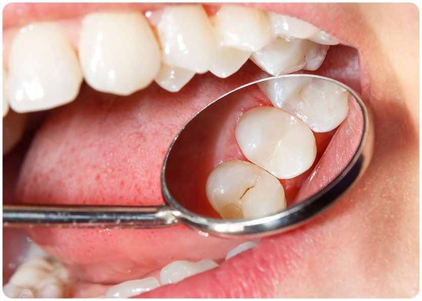 White Dental Fillings | River Harmony Dental | General & Family Dentist | Cochrane | Alberta