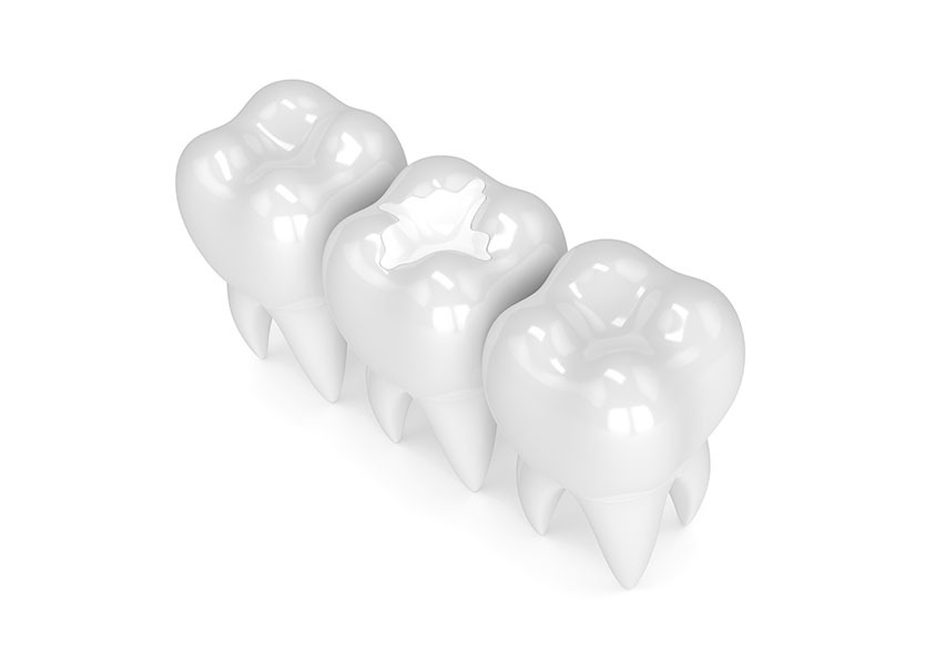 White Fillings | River Harmony Dental | General & Family Dentist | Cochrane | Alberta